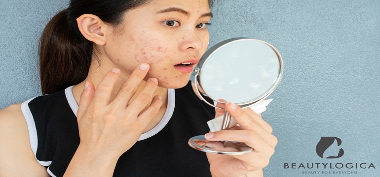 Hilangkan Jerawat Hingga Tuntas Berkat Beautylogica
